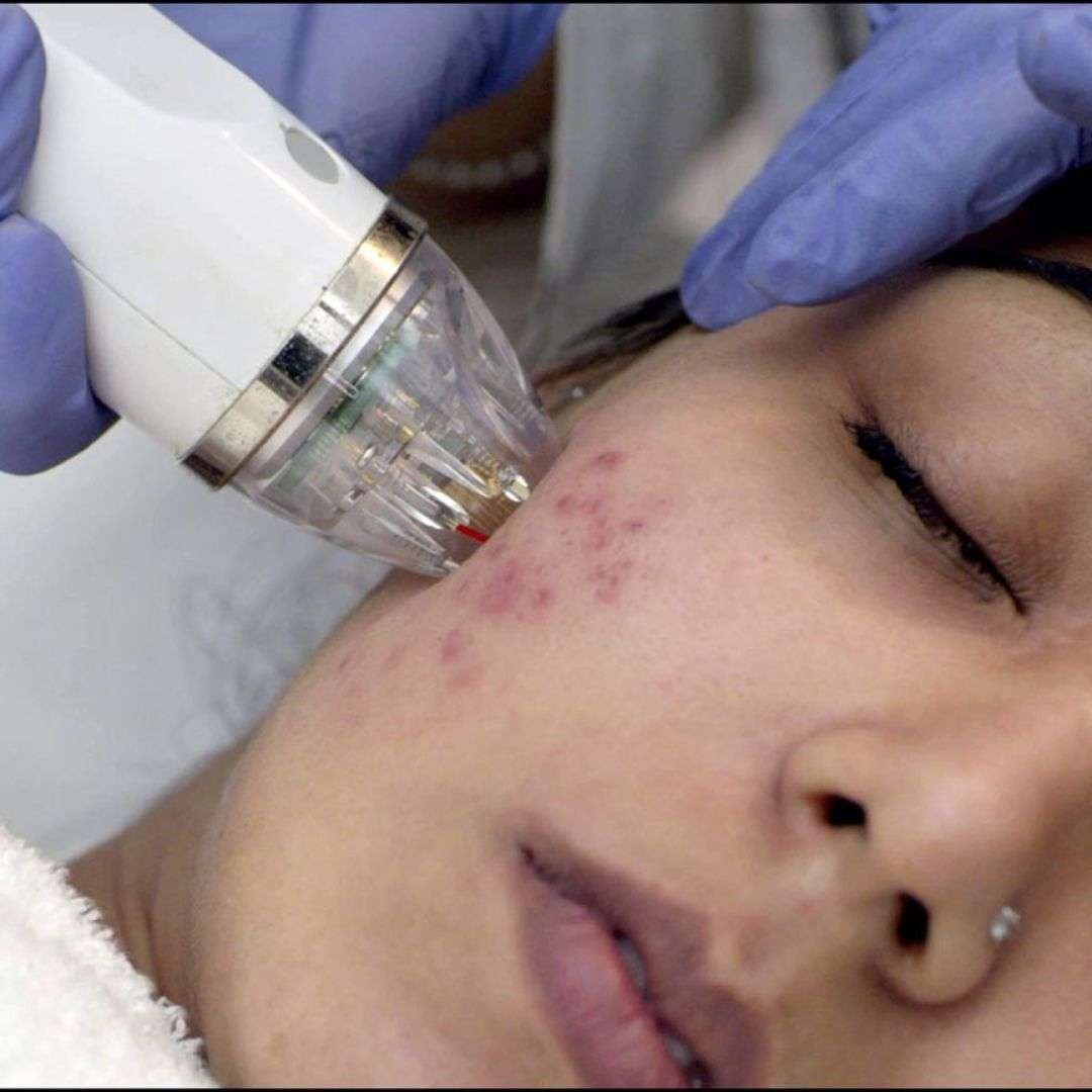MNRF Treatment