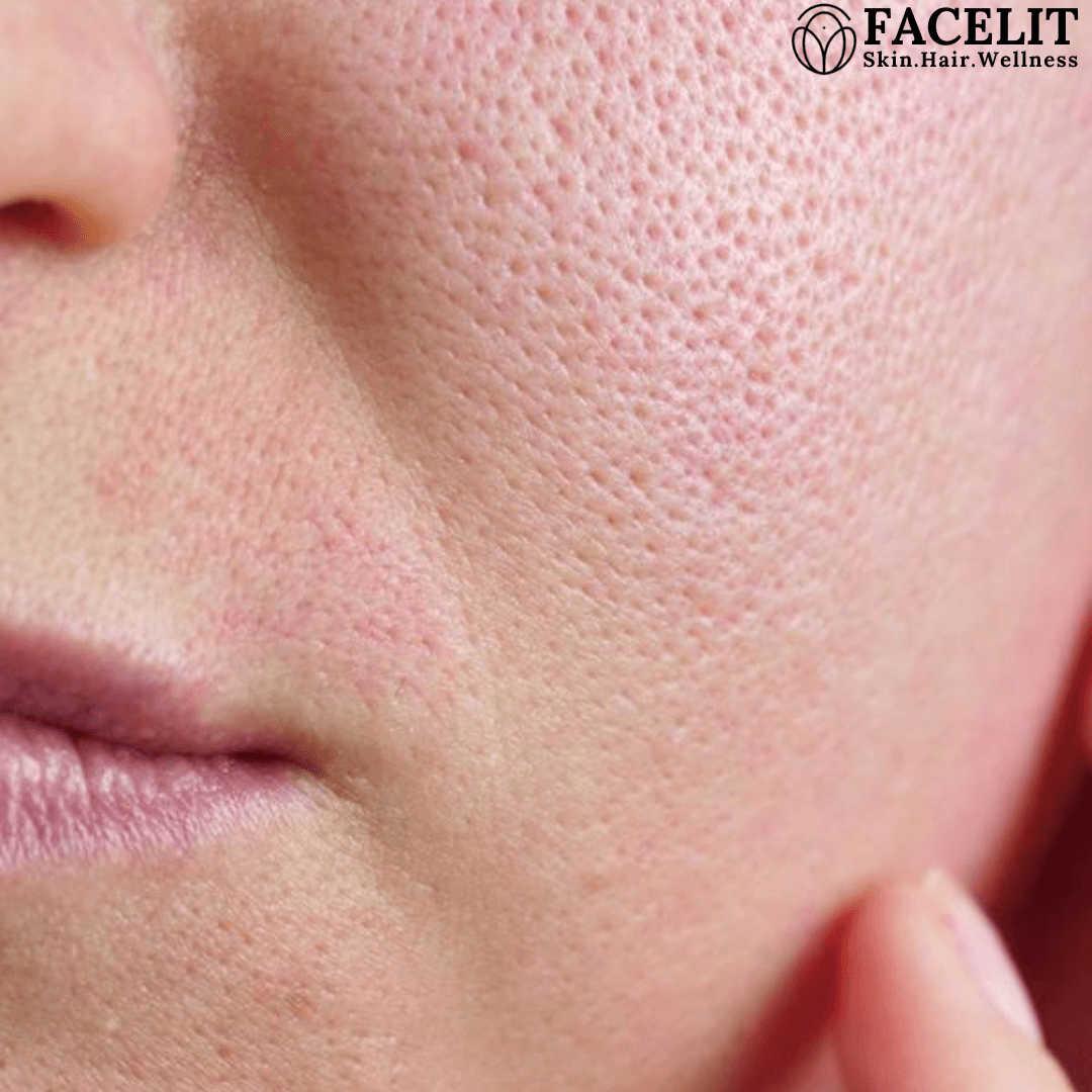How to Get Rid of Clogged Pores