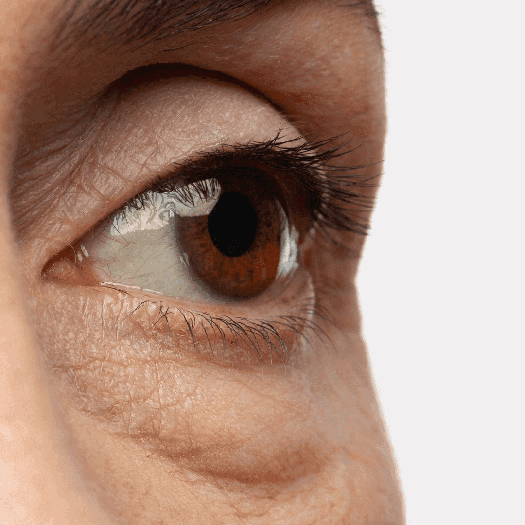 How to Get Rid of Under Eye Bags 7 Proven Ways