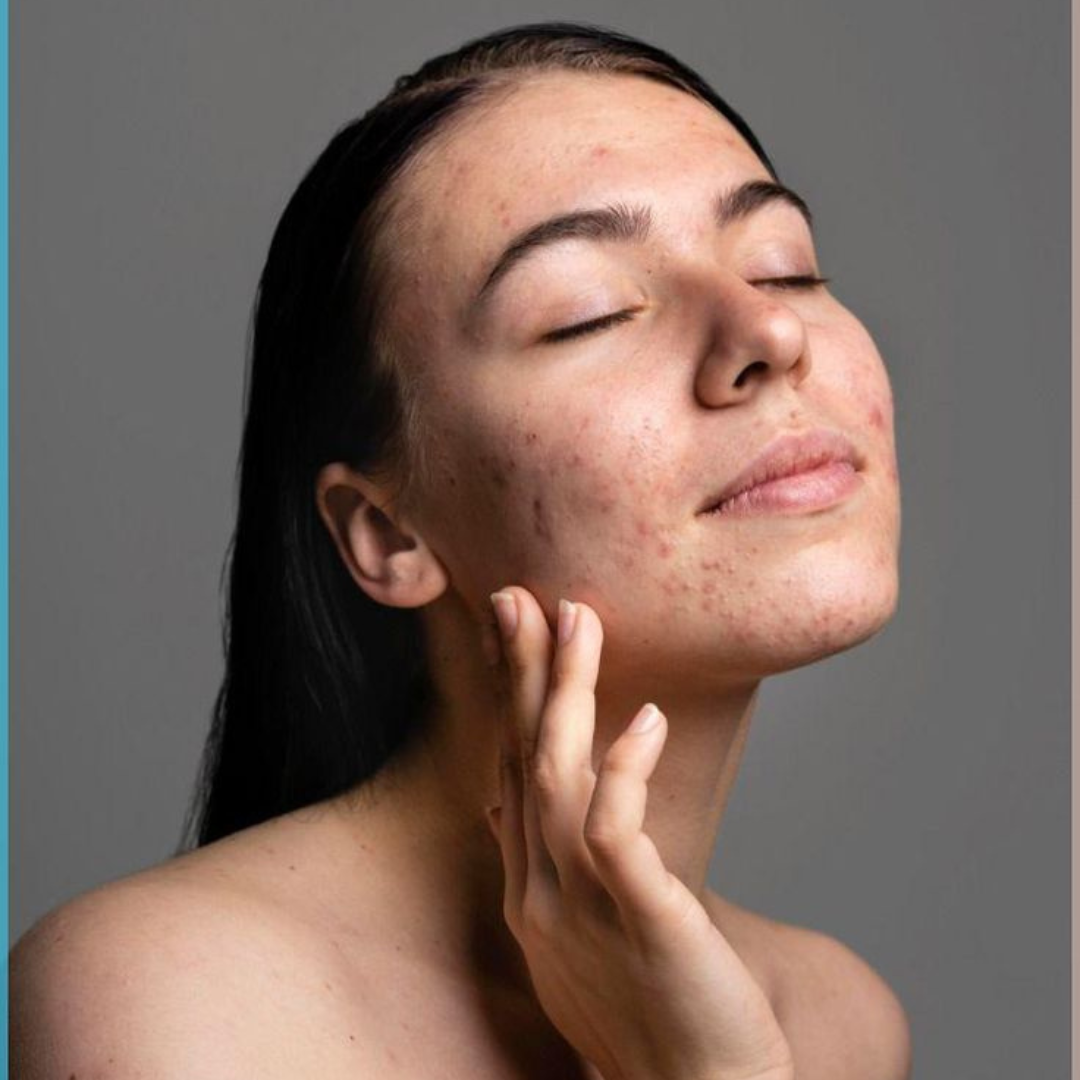 How To Get Rid of Pimple Marks from Face