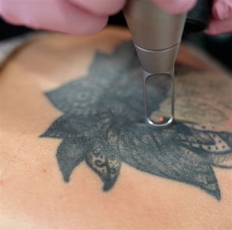 Everything You Need to Know About Permanent Tattoo Removal