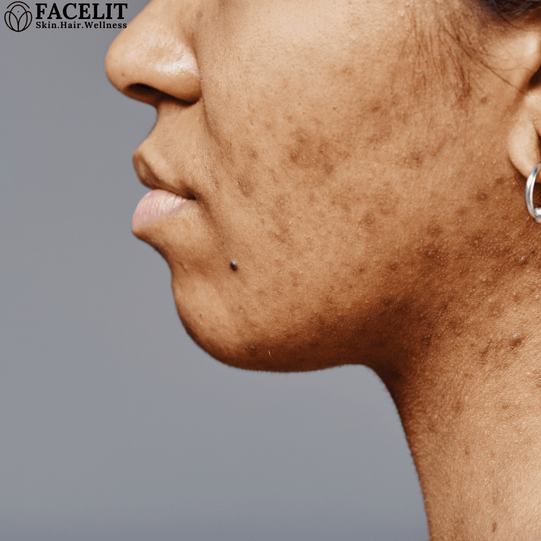 How to remove black marks on face quickly