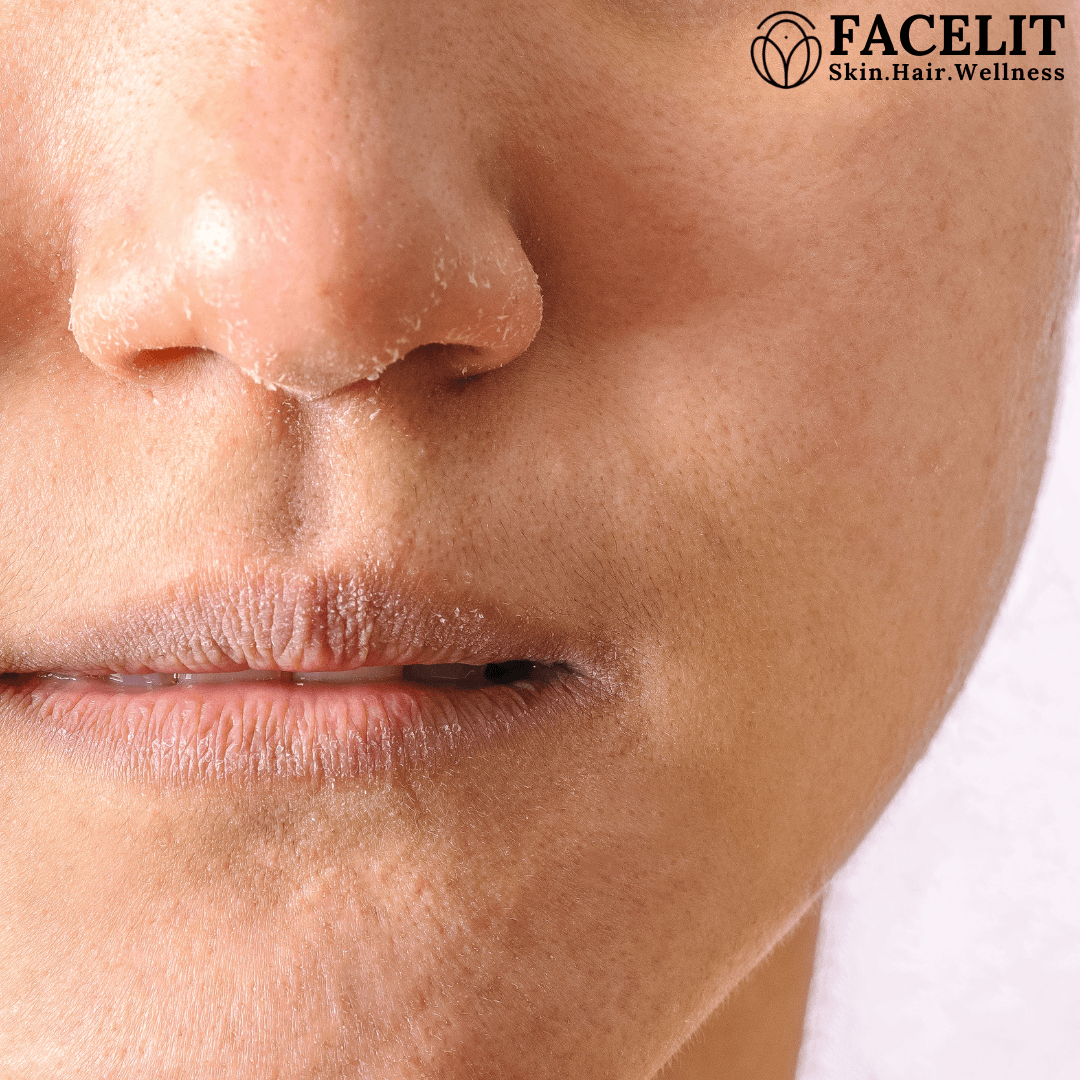 Ultimate Guide to Getting Rid of Dry Skin