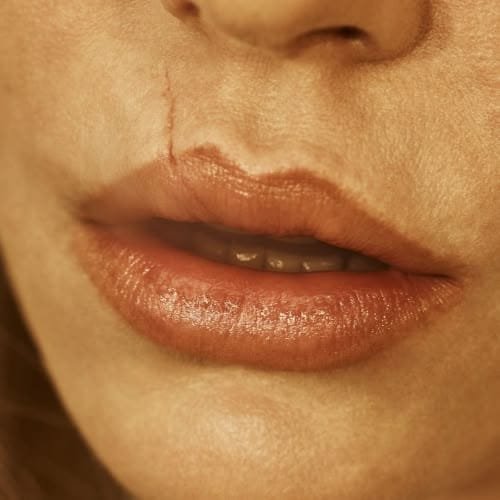 How to Remove Scars from Face Permanently