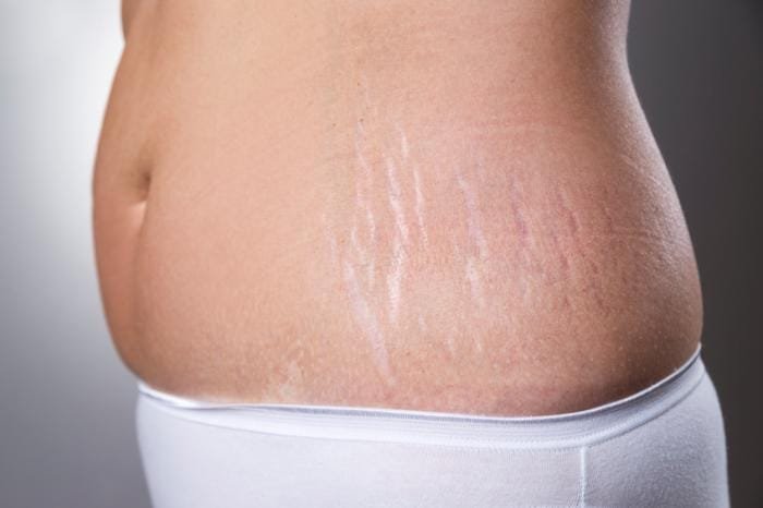 How Can You Reduce Stretch Marks with Advanced Treatments